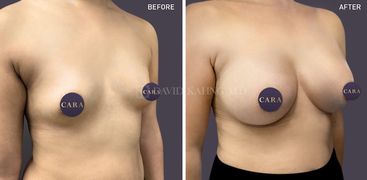 Breast Augmentation Before & After Gallery - Patient 147720825 - Image 1