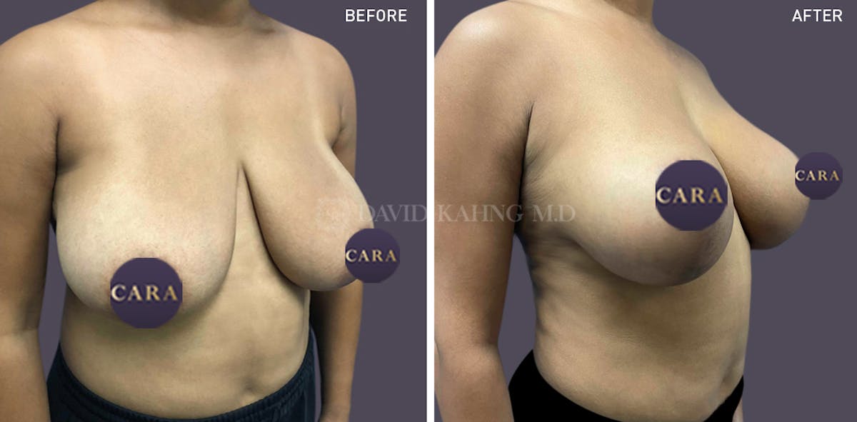 Breast Lift Before & After Gallery - Patient 147720840 - Image 2