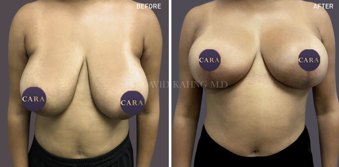 Breast Lift Before & After Gallery - Patient 147720840 - Image 1