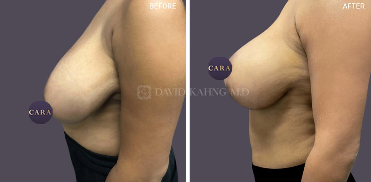 Breast Lift Before & After Gallery - Patient 147720840 - Image 3