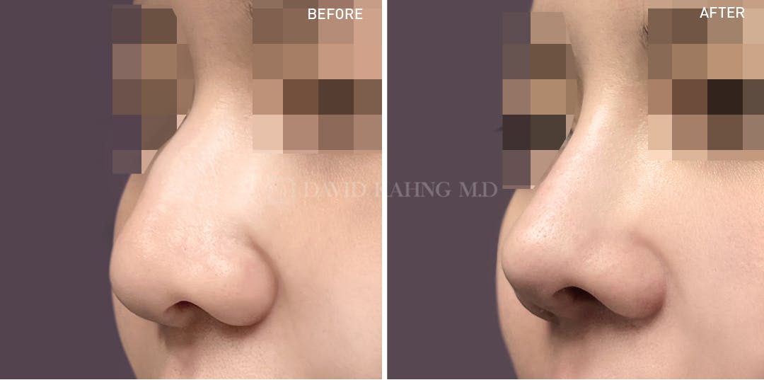 Rhinoplasty Before & After Gallery - Patient 148072293 - Image 1