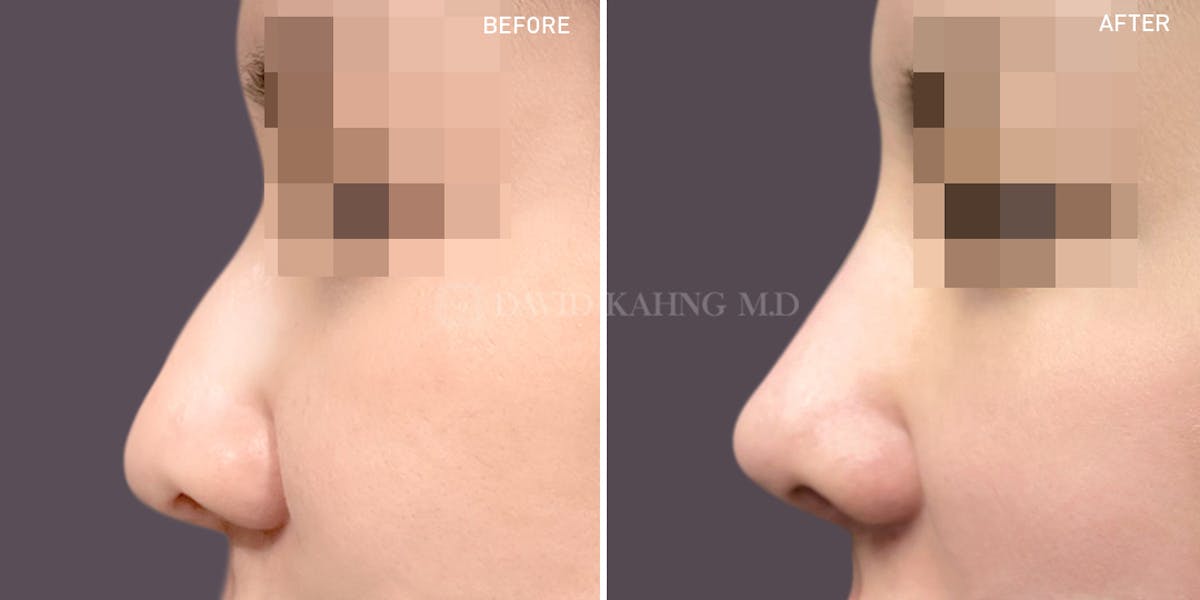 Rhinoplasty Before & After Gallery - Patient 148072292 - Image 1