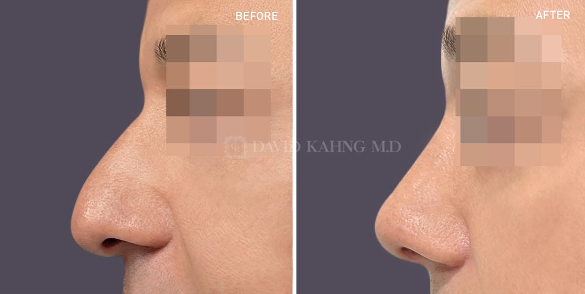 Rhinoplasty Before & After Gallery - Patient 148072291 - Image 1
