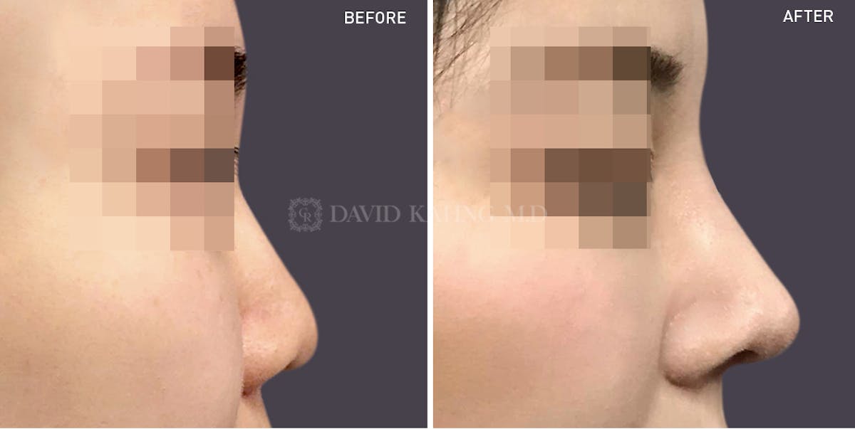 Rhinoplasty Before & After Gallery - Patient 148072290 - Image 1