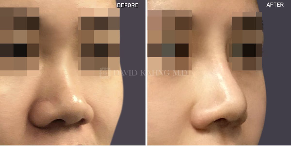 Rhinoplasty Before & After Gallery - Patient 148072289 - Image 1