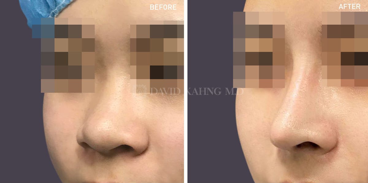 Rhinoplasty Before & After Gallery - Patient 148072288 - Image 1
