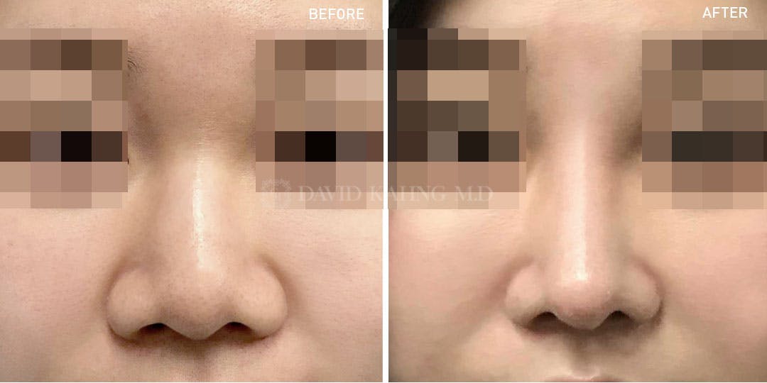 Rhinoplasty Before & After Gallery - Patient 148072287 - Image 1
