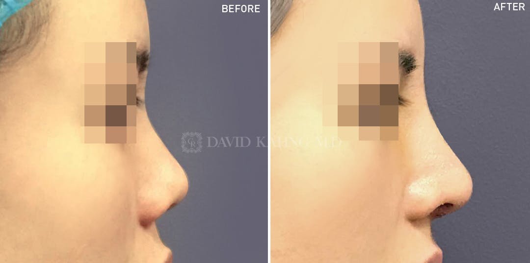 Rhinoplasty Before & After Gallery - Patient 148072286 - Image 1