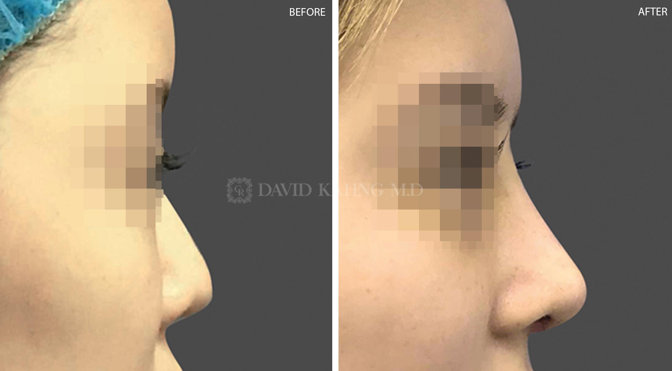 Rhinoplasty Before & After Gallery - Patient 148072285 - Image 1