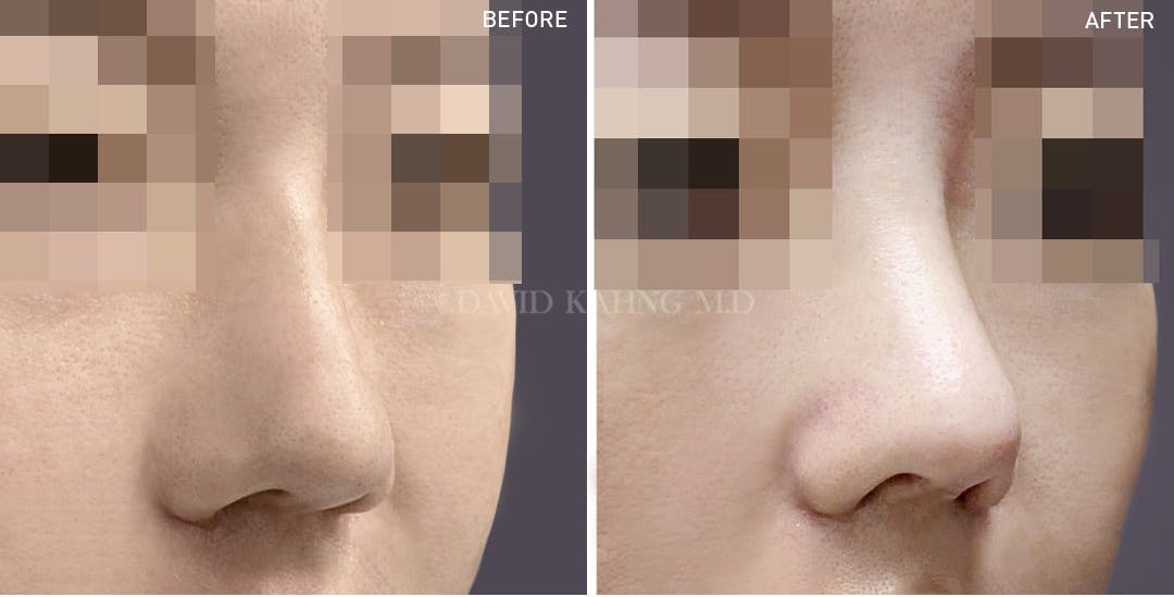 Rhinoplasty Before & After Gallery - Patient 148072284 - Image 1