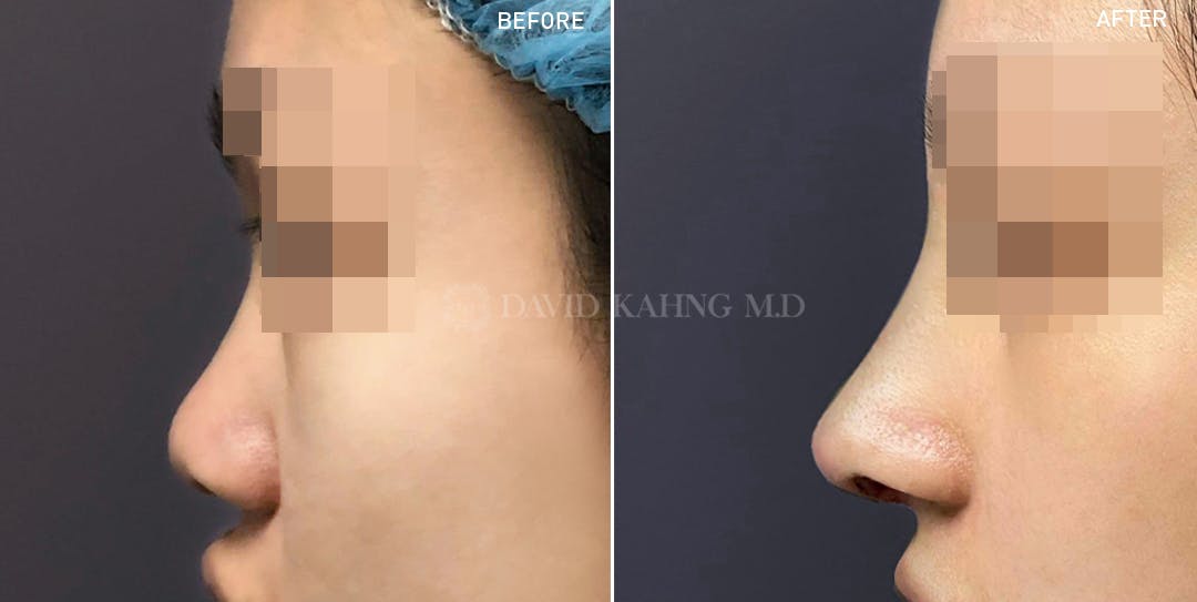 Rhinoplasty Before & After Gallery - Patient 148072283 - Image 1