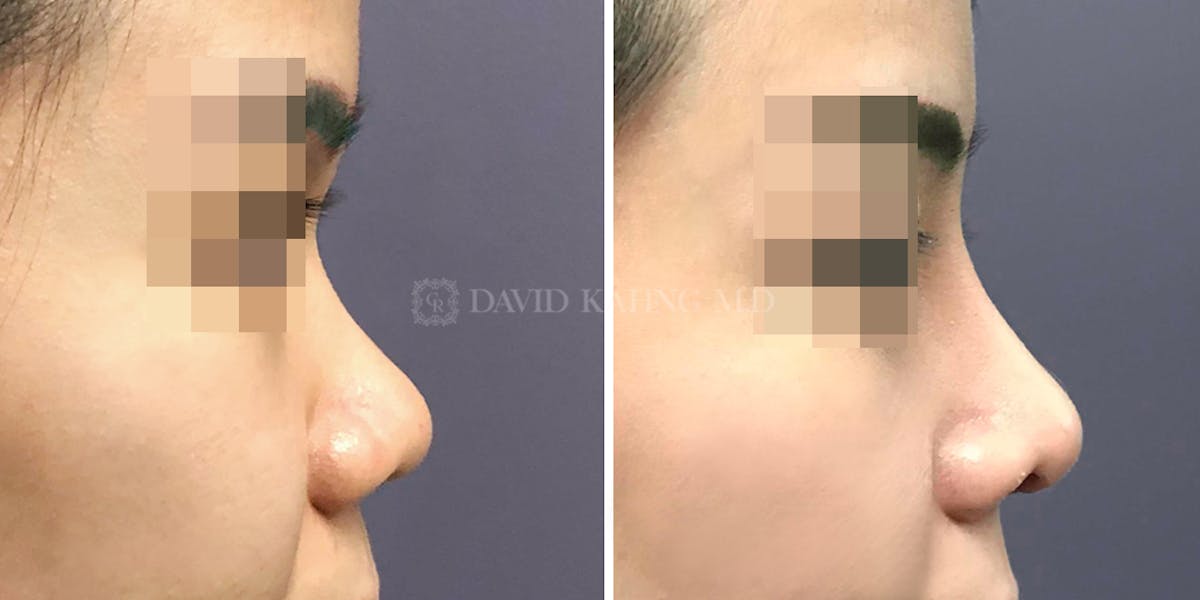 Rhinoplasty Before & After Gallery - Patient 148072282 - Image 1