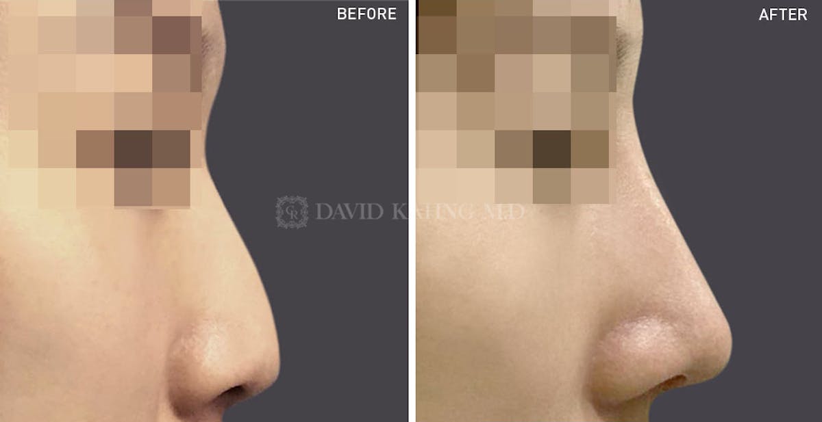 Rhinoplasty Before & After Gallery - Patient 148072281 - Image 1