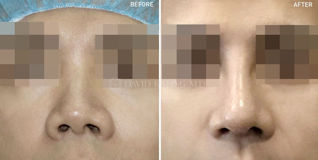 Rhinoplasty Before & After Gallery - Patient 148072280 - Image 1