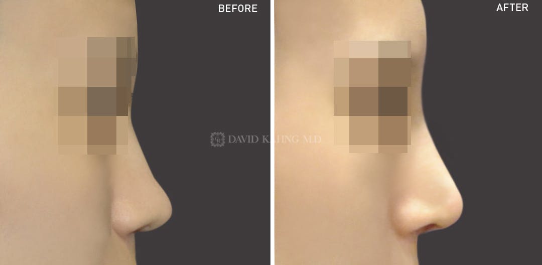 Rhinoplasty Before & After Gallery - Patient 148072279 - Image 1