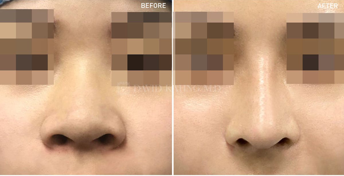 Rhinoplasty Before & After Gallery - Patient 148072278 - Image 1