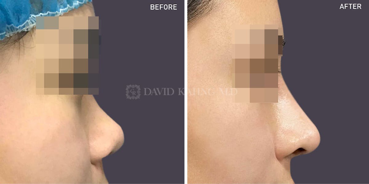 Rhinoplasty Before & After Gallery - Patient 148072277 - Image 1