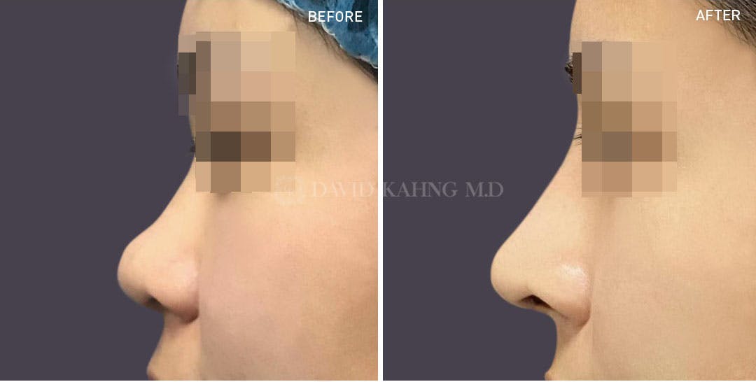 Rhinoplasty Before & After Gallery - Patient 148072276 - Image 1