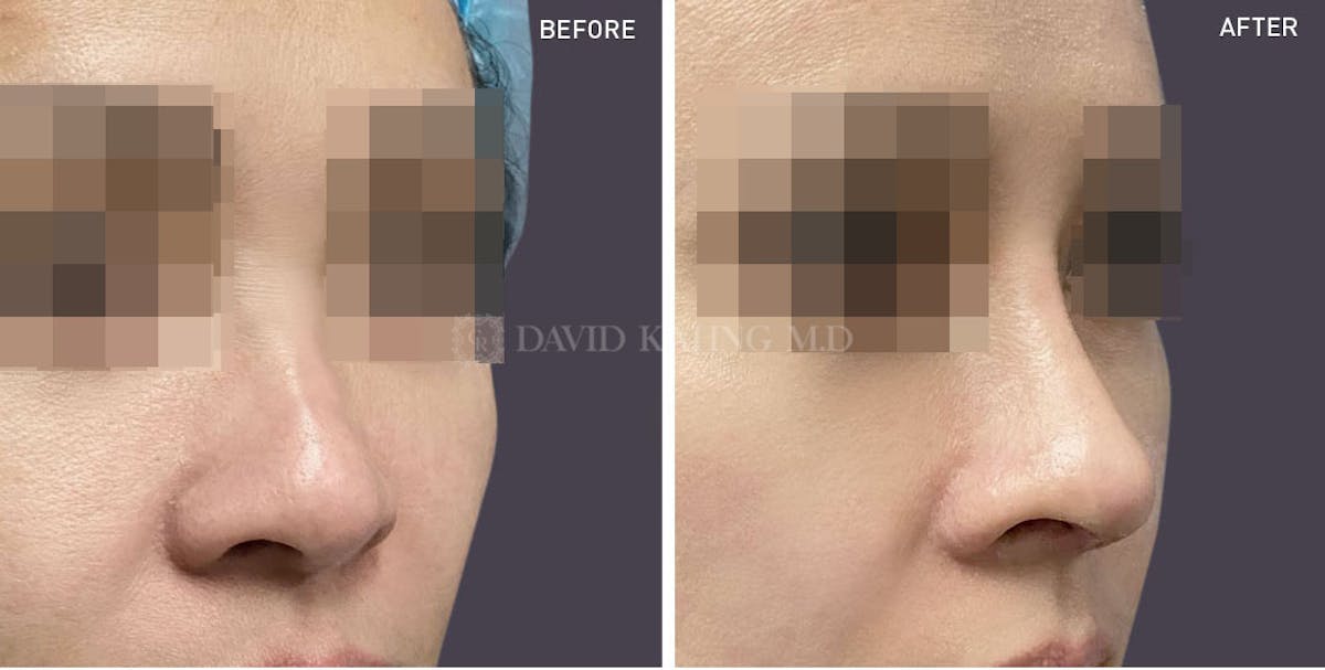 Rhinoplasty Before & After Gallery - Patient 148072275 - Image 1