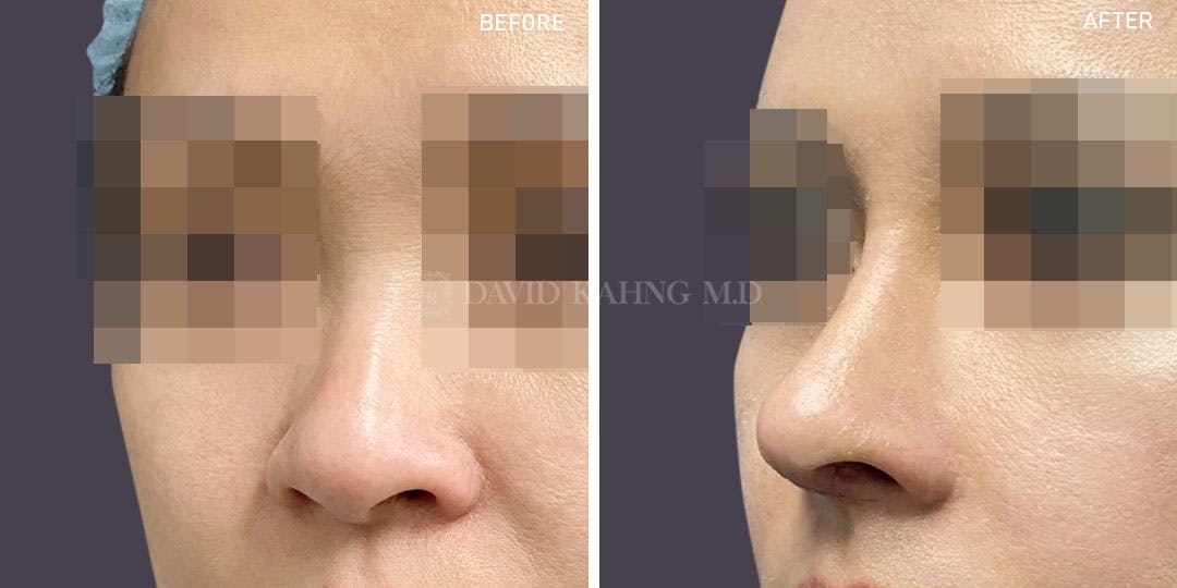 Rhinoplasty Before & After Gallery - Patient 148072274 - Image 1