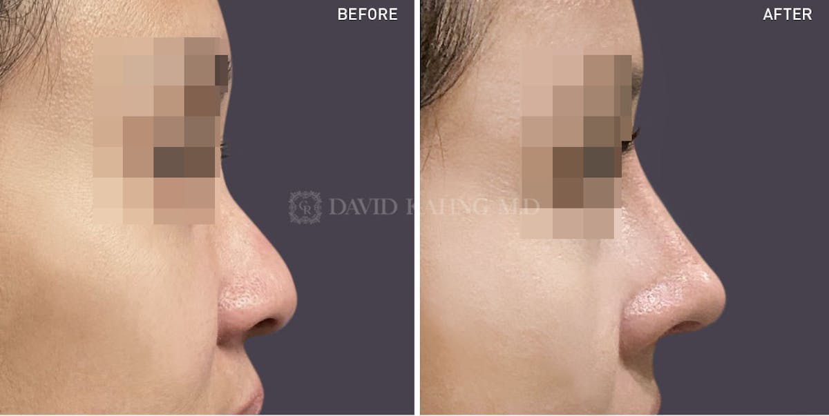 Rhinoplasty Before & After Gallery - Patient 148072273 - Image 1