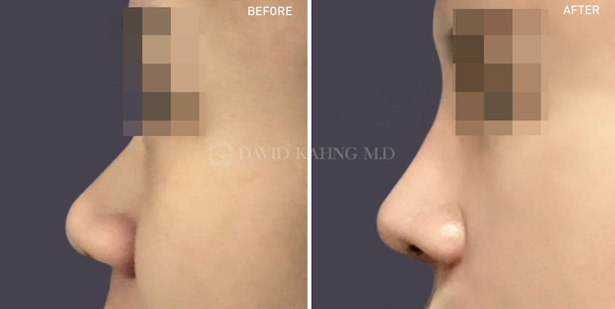 Rhinoplasty Before & After Gallery - Patient 148072272 - Image 1