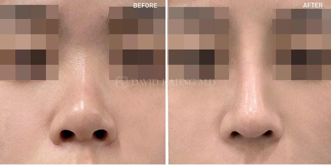 Rhinoplasty Before & After Gallery - Patient 148072271 - Image 1