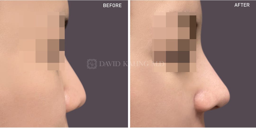 Rhinoplasty Before & After Gallery - Patient 148072270 - Image 1