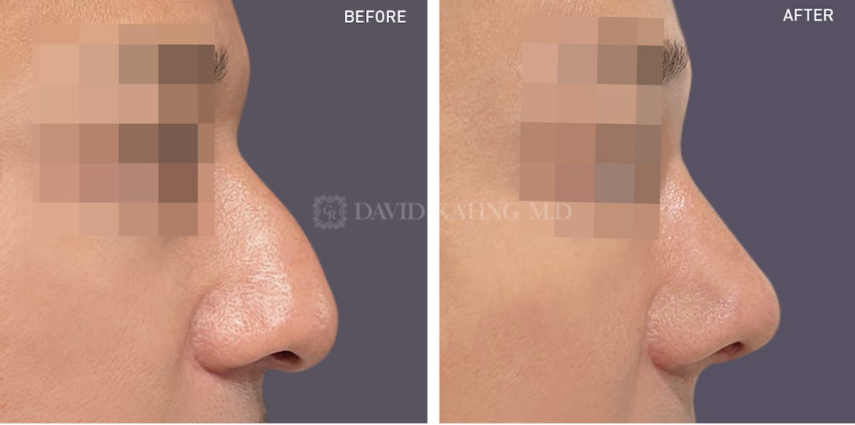 Rhinoplasty Before & After Gallery - Patient 148072269 - Image 1