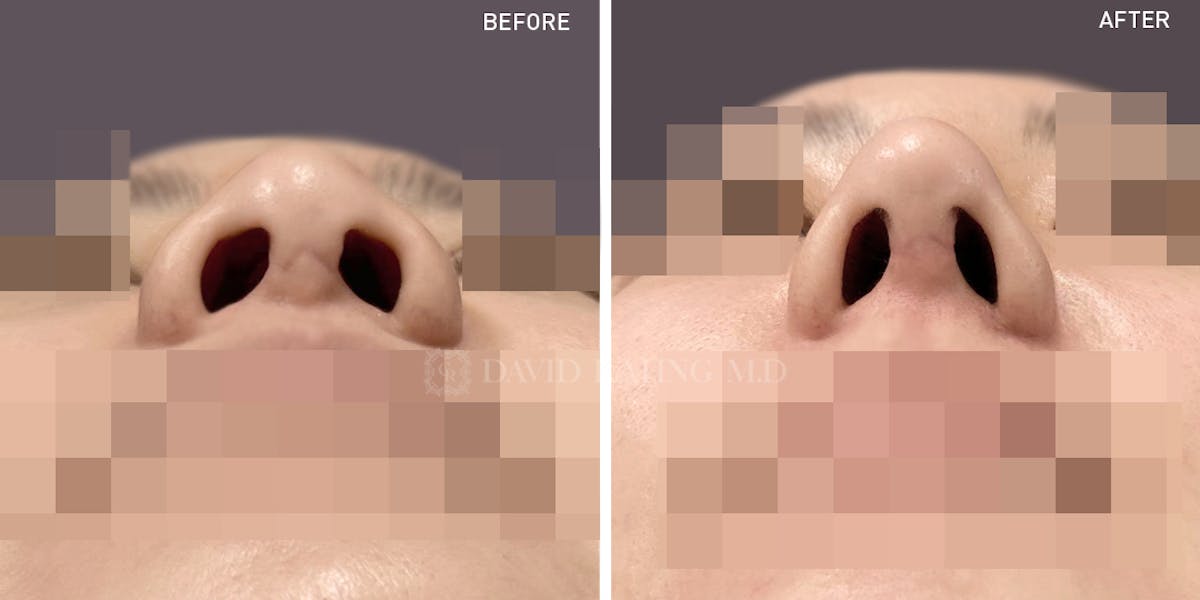 Rhinoplasty Before & After Gallery - Patient 148072268 - Image 1