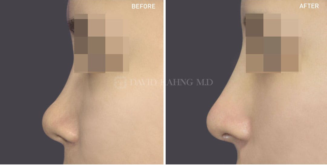 Rhinoplasty Before & After Gallery - Patient 148072267 - Image 1