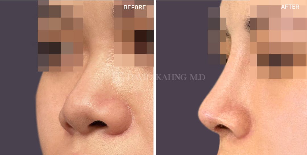 Rhinoplasty Before & After Gallery - Patient 148072266 - Image 1