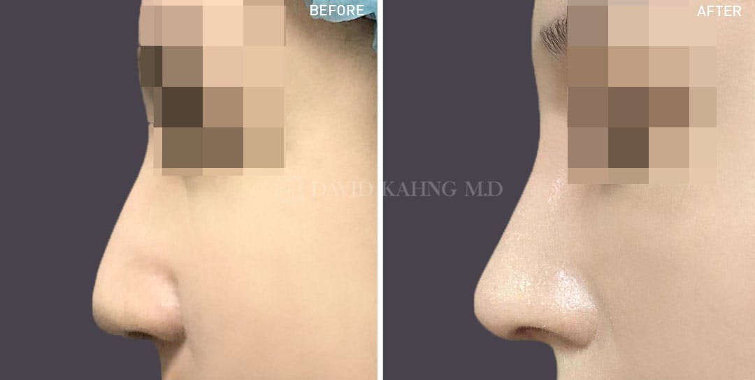 Rhinoplasty Before & After Gallery - Patient 148072265 - Image 1
