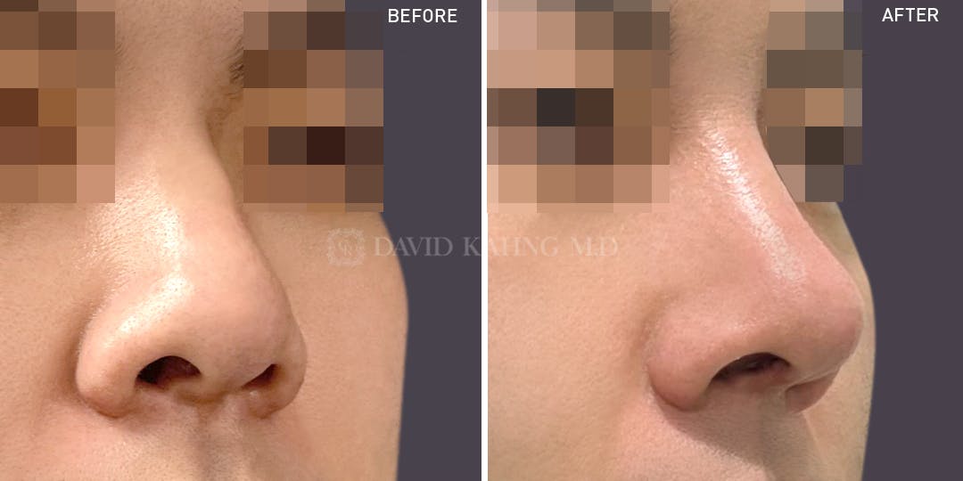 Rhinoplasty Before & After Gallery - Patient 148072264 - Image 1