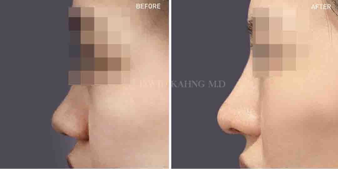 Rhinoplasty Before & After Gallery - Patient 148072263 - Image 1