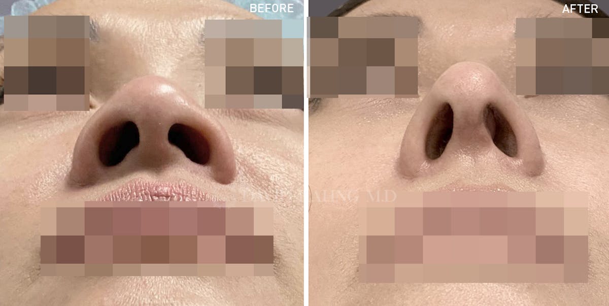 Rhinoplasty Before & After Gallery - Patient 148072262 - Image 1