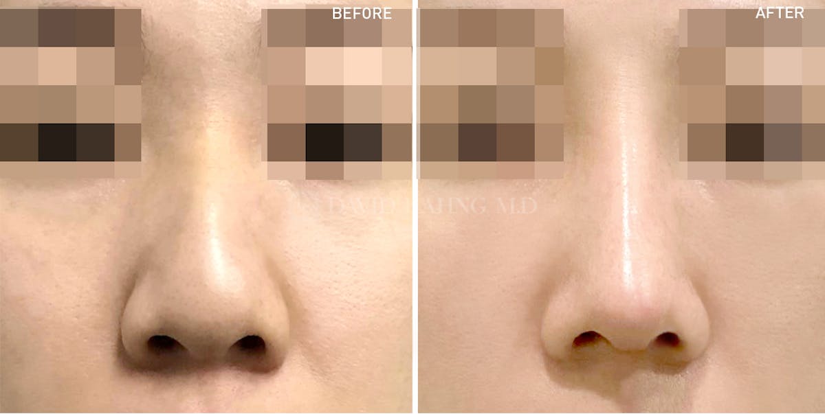 Rhinoplasty Before & After Gallery - Patient 148072261 - Image 1