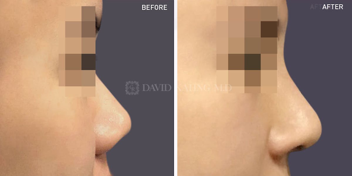Rhinoplasty Before & After Gallery - Patient 148072260 - Image 1
