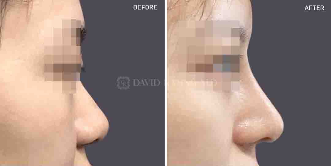 Rhinoplasty Before & After Gallery - Patient 148072253 - Image 1