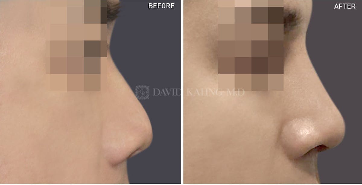 Rhinoplasty Before & After Gallery - Patient 148072252 - Image 1