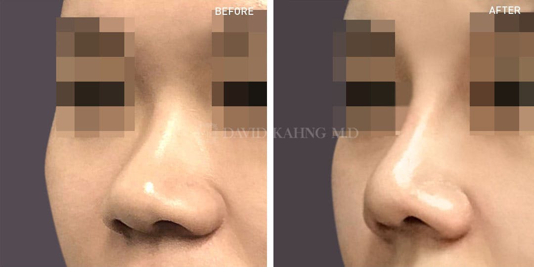 Rhinoplasty Before & After Gallery - Patient 148072257 - Image 1