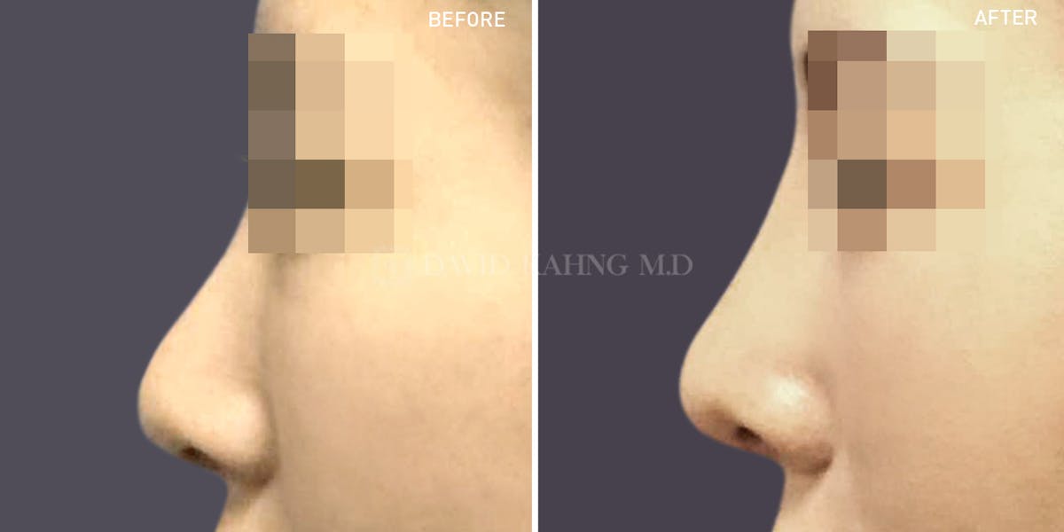 Rhinoplasty Before & After Gallery - Patient 148072256 - Image 1
