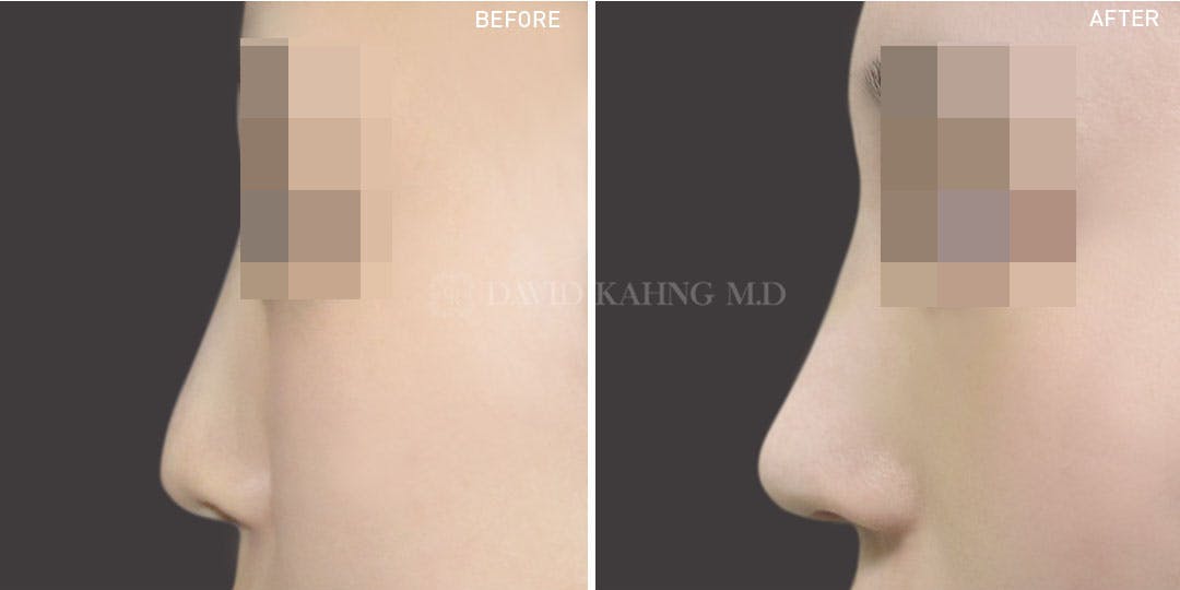 Rhinoplasty Before & After Gallery - Patient 148072255 - Image 1