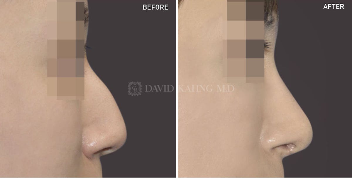 Rhinoplasty Before & After Gallery - Patient 148072254 - Image 1