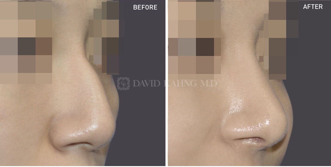 Rhinoplasty Before & After Gallery - Patient 148072247 - Image 1