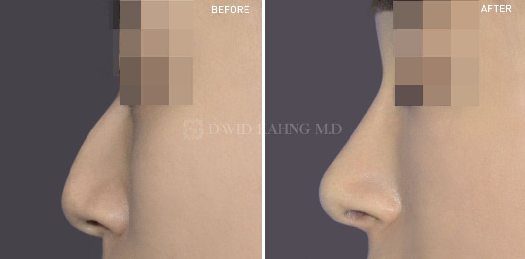 Rhinoplasty Before & After Gallery - Patient 148072246 - Image 1