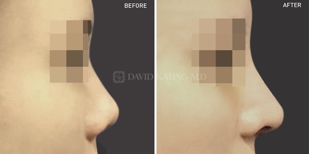 Rhinoplasty Before & After Gallery - Patient 148072245 - Image 1