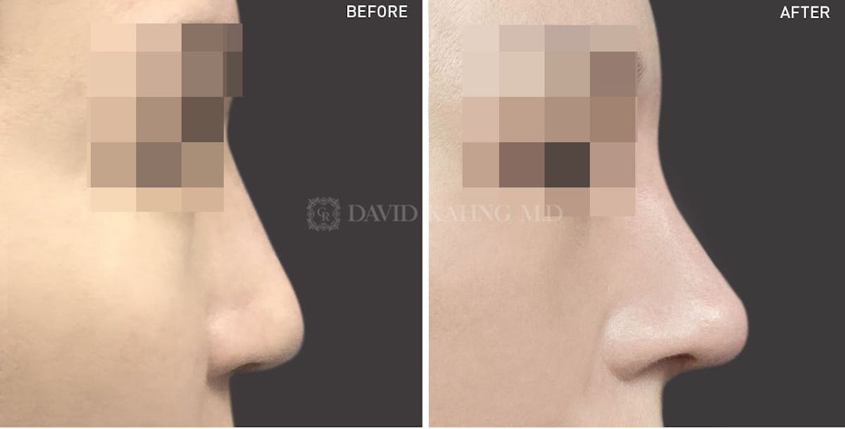 Rhinoplasty Before & After Gallery - Patient 148072244 - Image 1