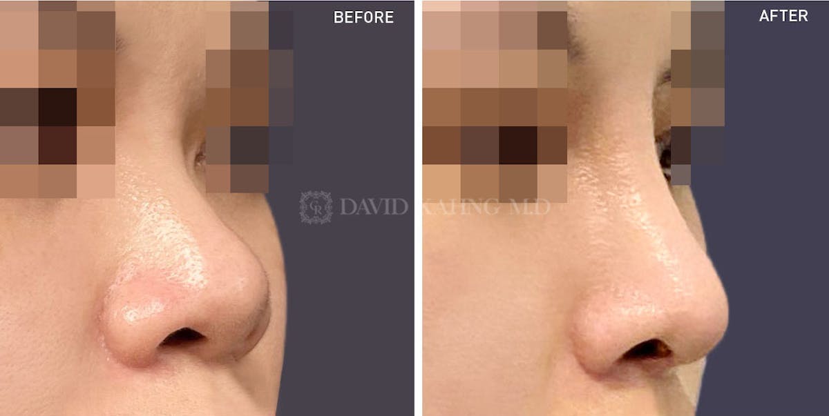 Rhinoplasty Before & After Gallery - Patient 148072243 - Image 1