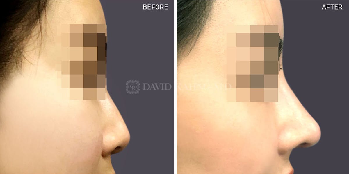 Rhinoplasty Before & After Gallery - Patient 148072241 - Image 1